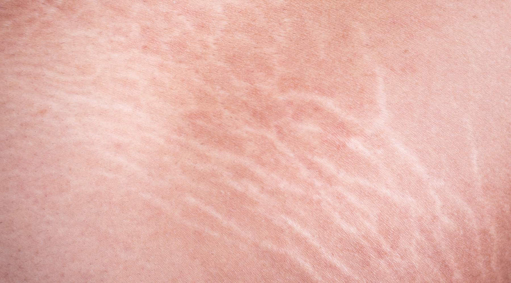 Understanding Stretch Marks