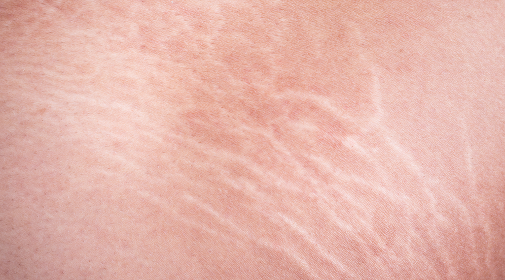 Understanding Stretch Marks